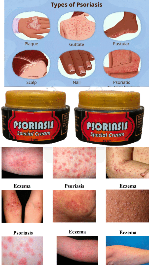 Psoriasis special cream pack of 2