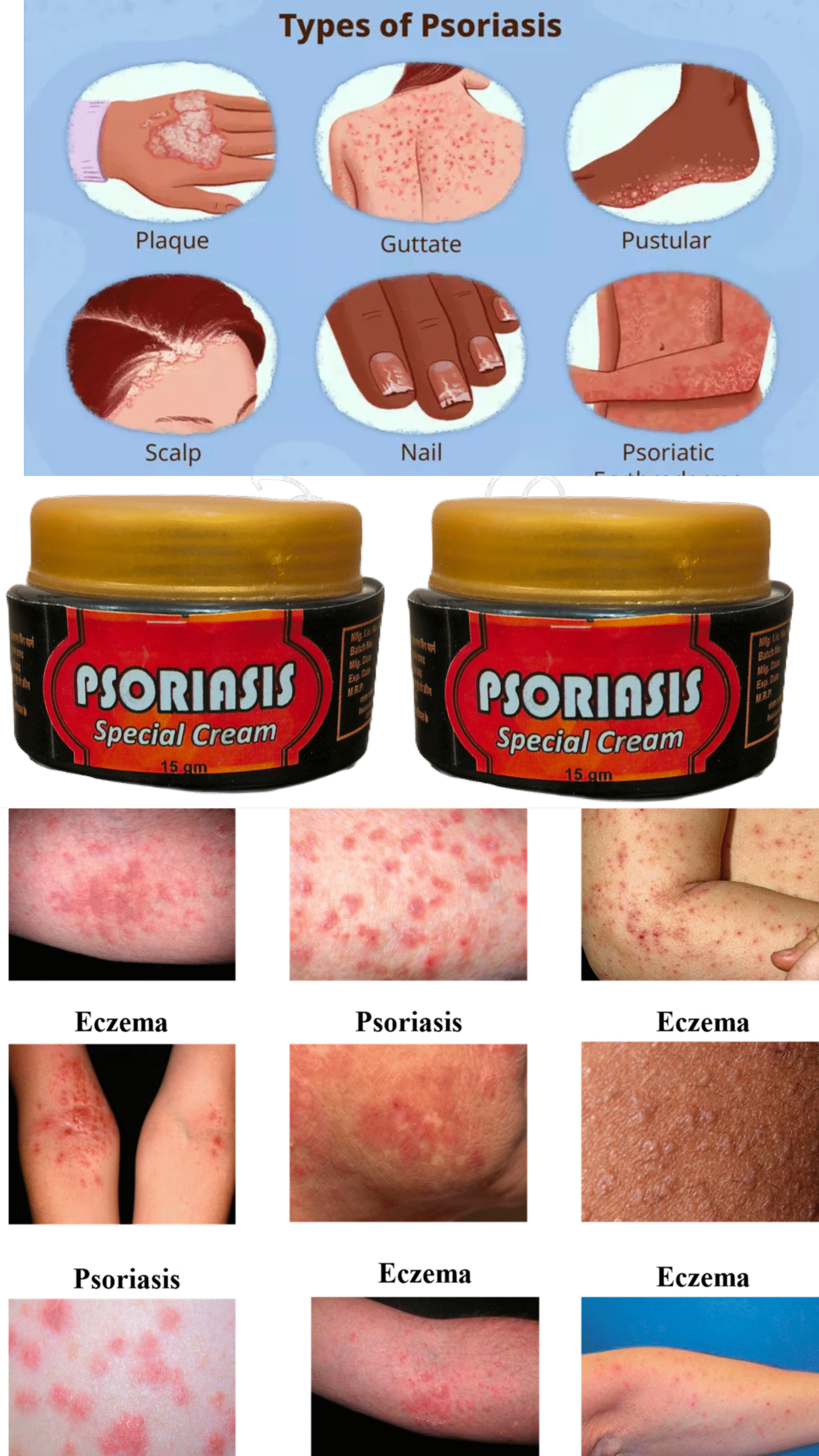 Psoriasis special cream pack of 2